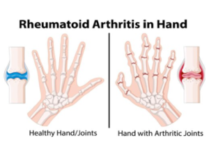 Rheumatoid Arthritis in hand