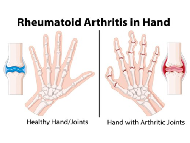 Arthritis | Quicfrac Blogs